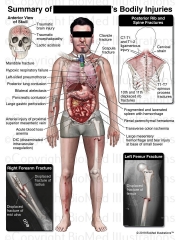 Summary of Traumatic Injuries