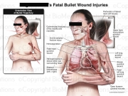 Summary of Fatal Bullet Wound Injuries