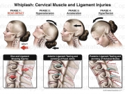 Cervical Spine Whiplash Injuries