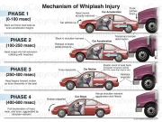 Whiplash: Mechanism of Injury