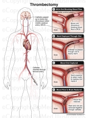 Thrombectomy