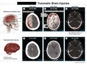 Brain Bleed Injuries