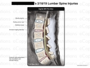 Cervical Spine Injuries