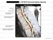 Cervical Spine Injuries