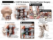 Anterior Cervical Disc Fusion