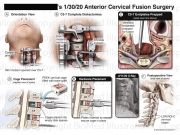 Anterior Cervical Disc Fusion