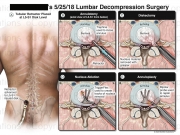 Lumbar Decompression Surgery