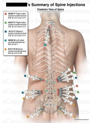 Summary of Spine Injections