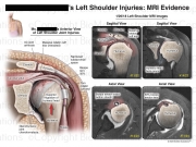 Left Shoulder Injuries