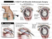 Left Shoulder Arthroscopic Surgery