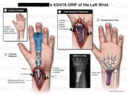 Left Wrist Surgery