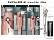 Tibial IM Nailing Surgery