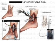 Left Ankle Surgery