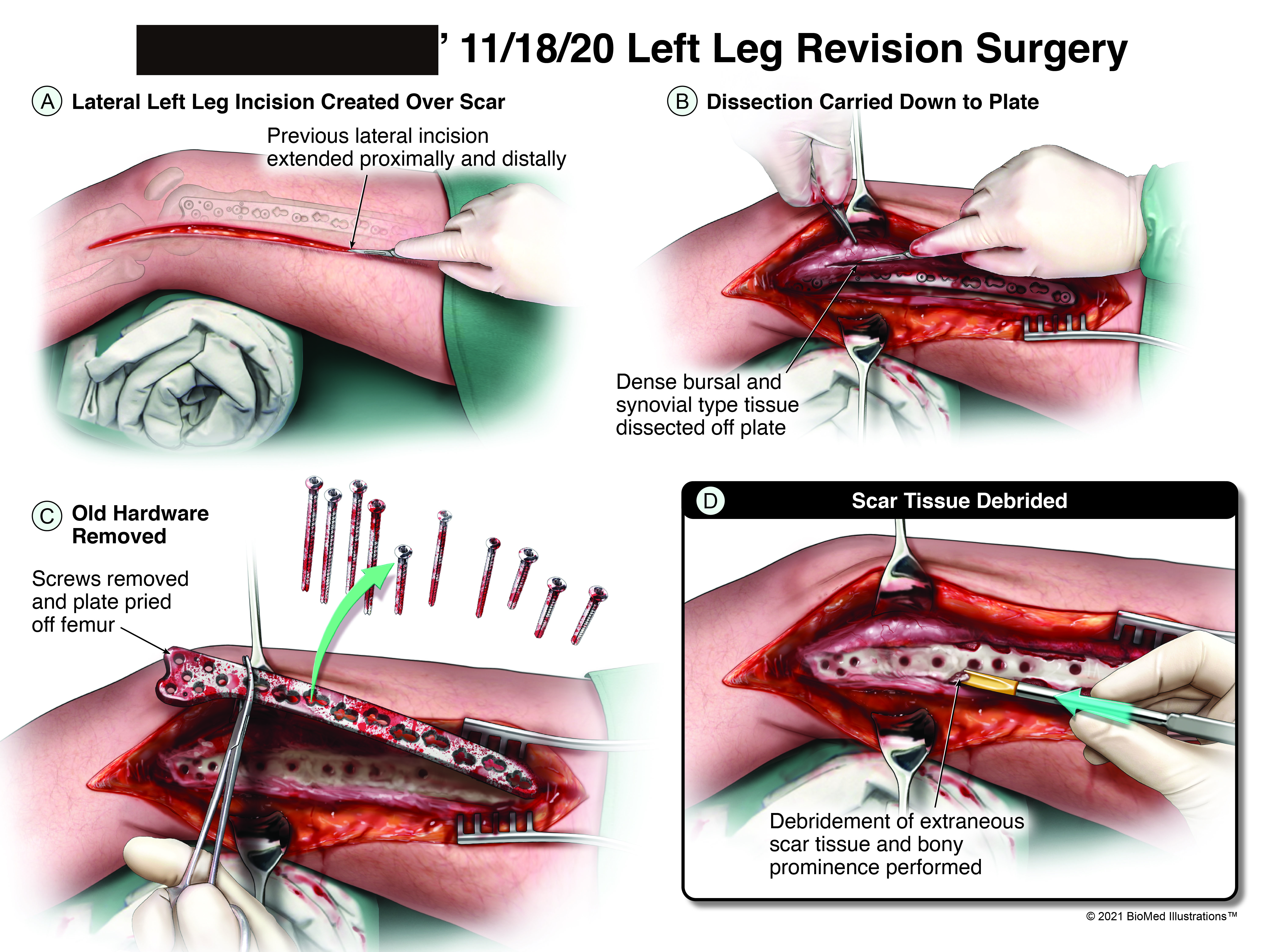 Leg Revision-Surgery
