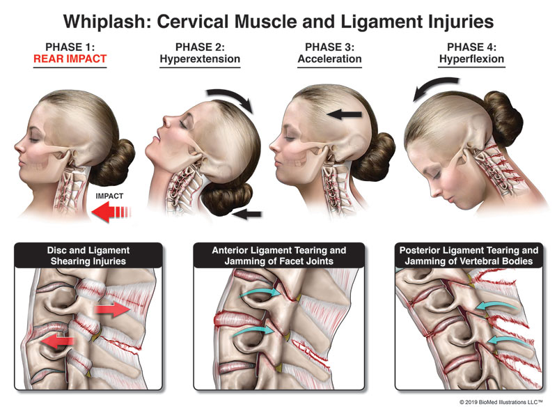Whiplash Cervical Spine Injuries