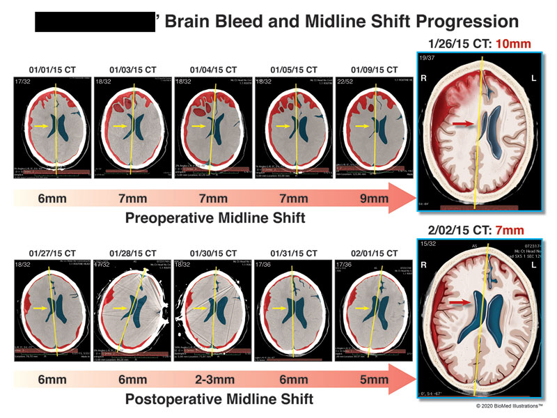 Brain Bleed Progression