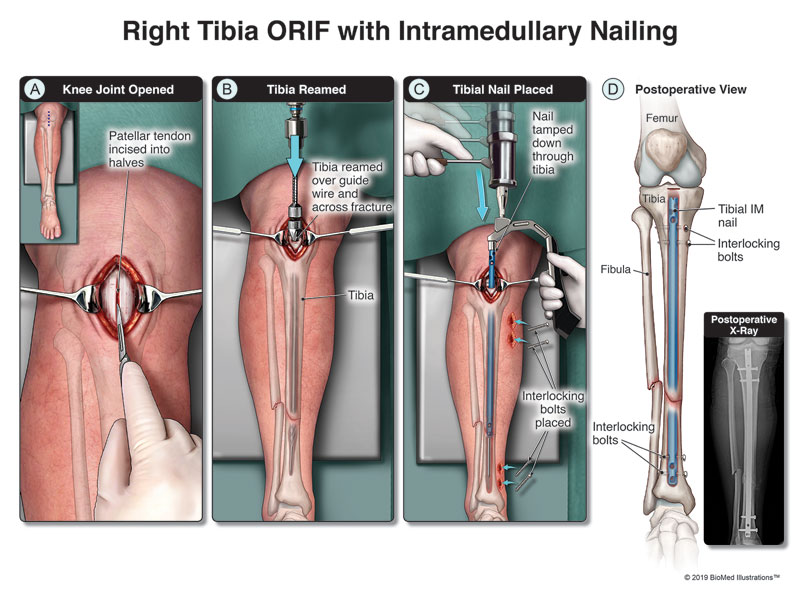 Tibial IM Nailing Surgery